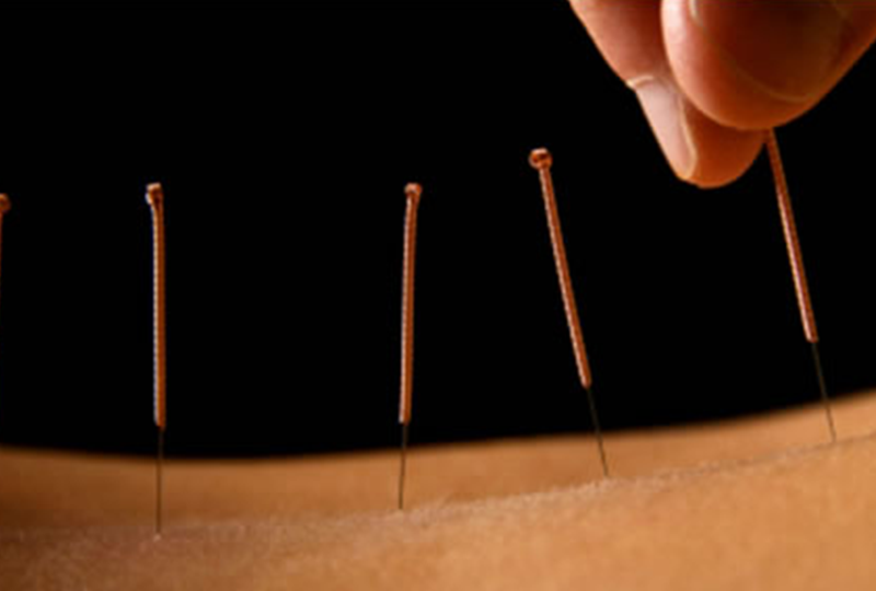 acupuncture